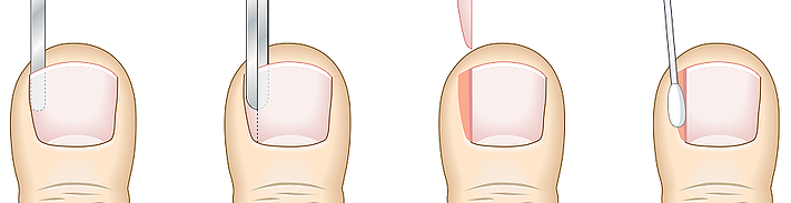Ingowing toenails and gait - Get fixed at Compleet Feet. Treat the cause.