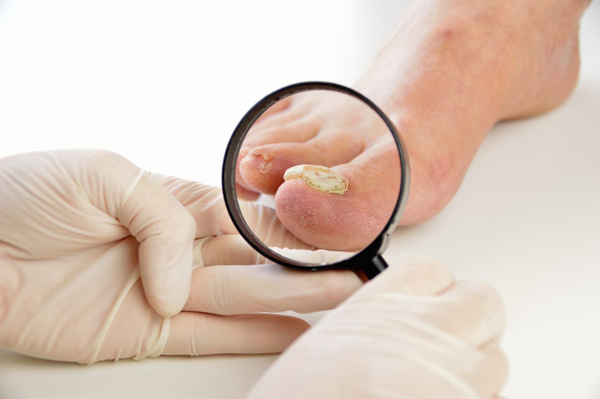 Exploring the population increase of people with fungal nail infections