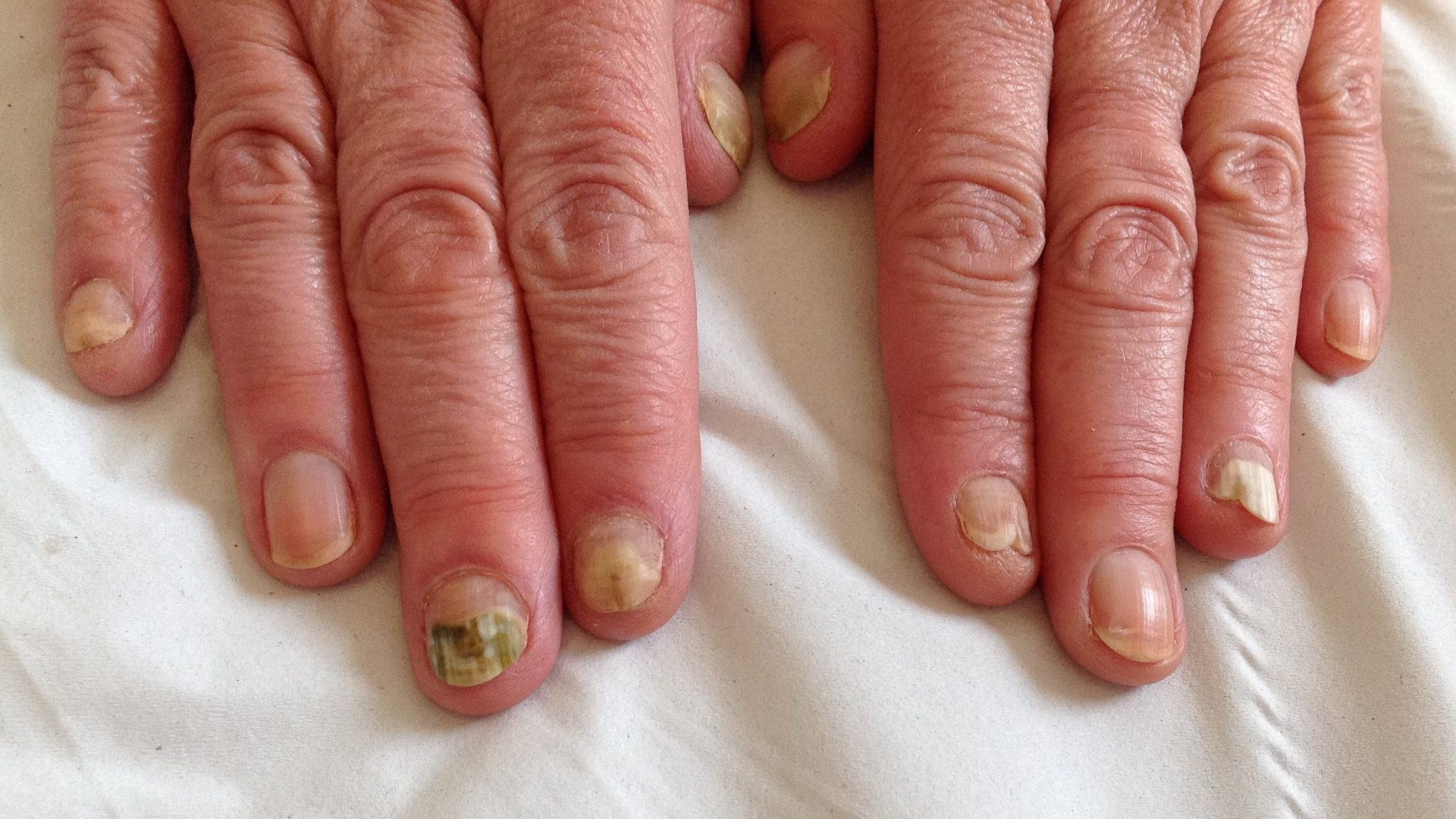 PDF) Green nail syndrome