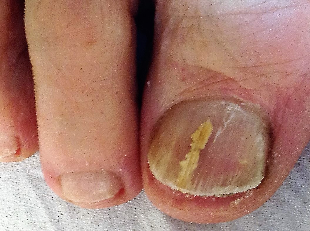Difficulties of Treating a Fungal Nail Dermatophytoma with a Biofilm: Why Treatments Can Fail