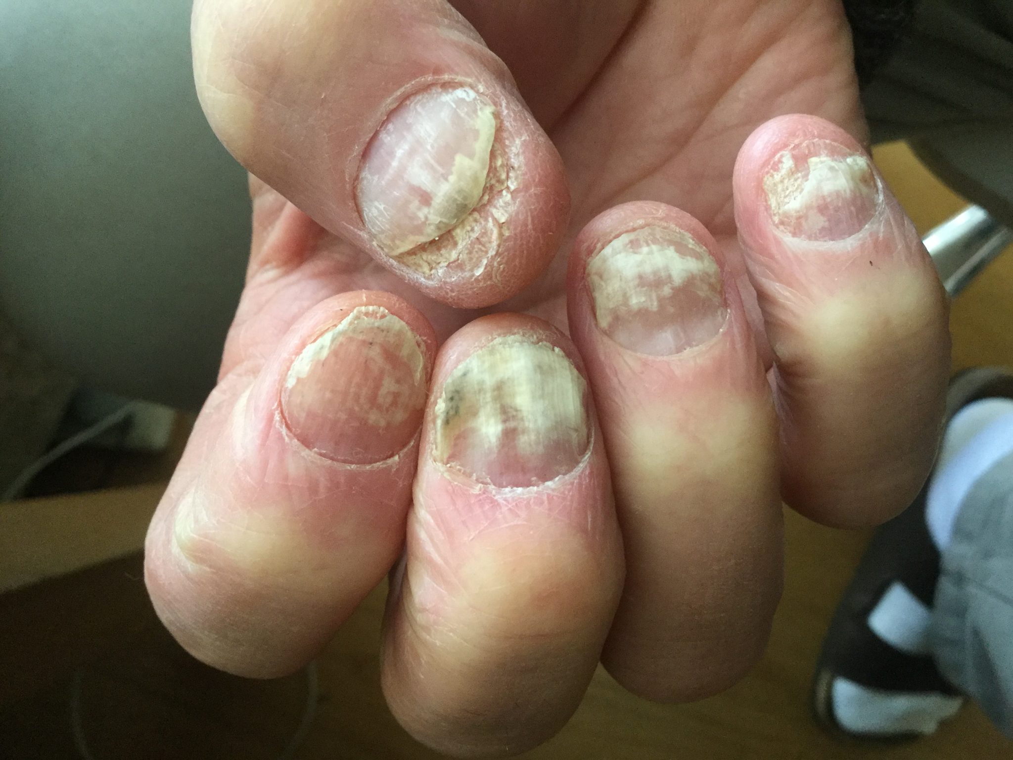 Fingernail treatment sales