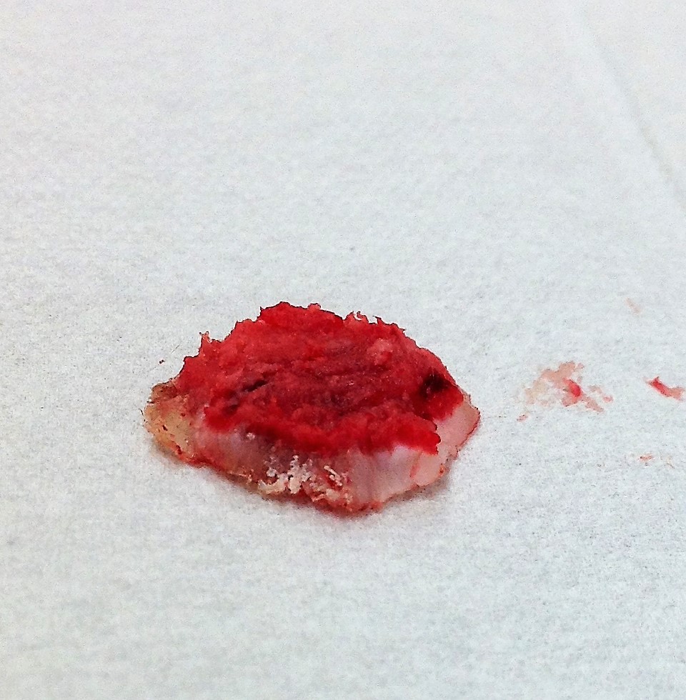 Quick Laser Verruca Solutions for  Treatment Resistant One