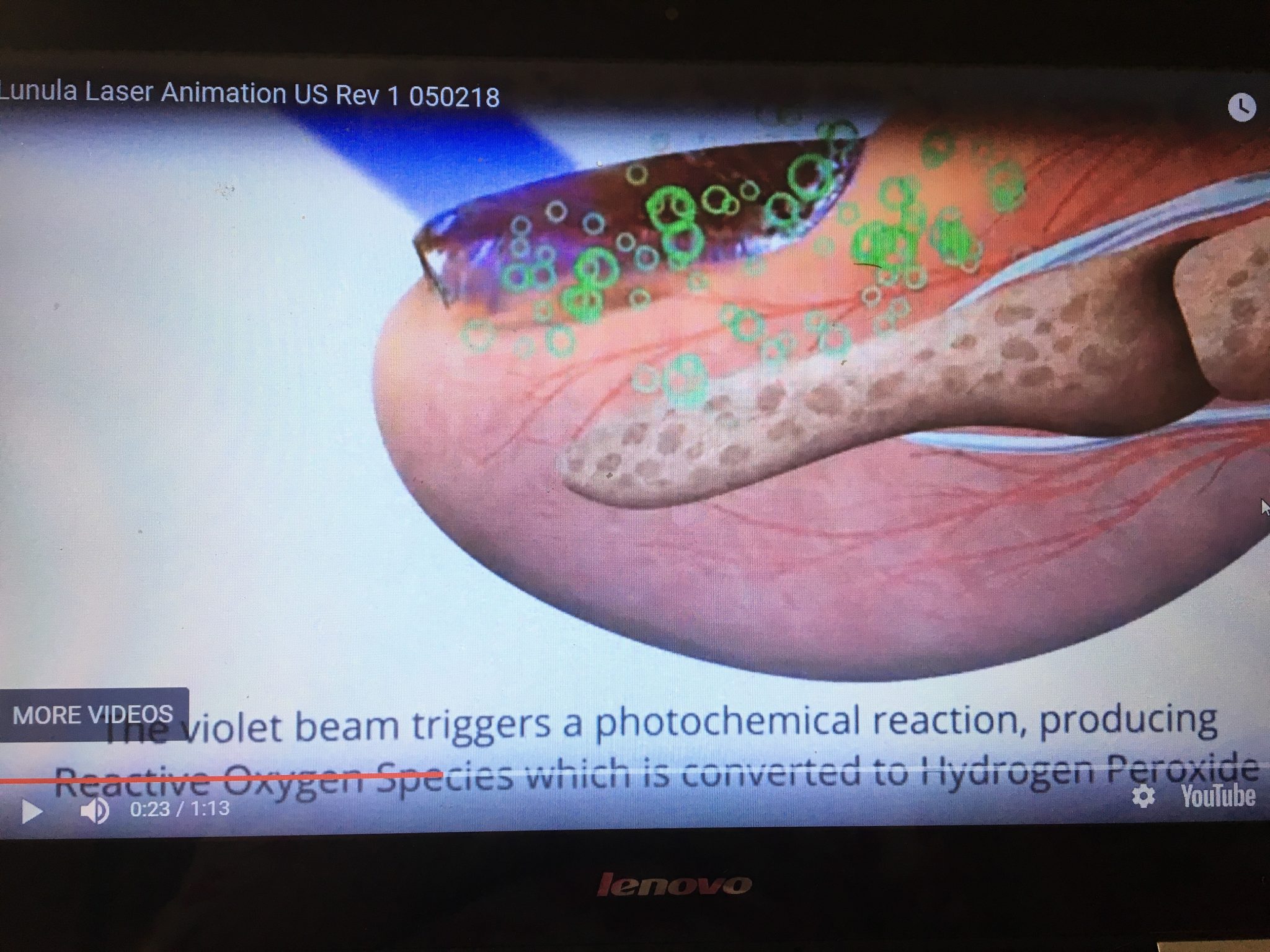 New Lunula Laser Fungal Nail Video From Erchonia