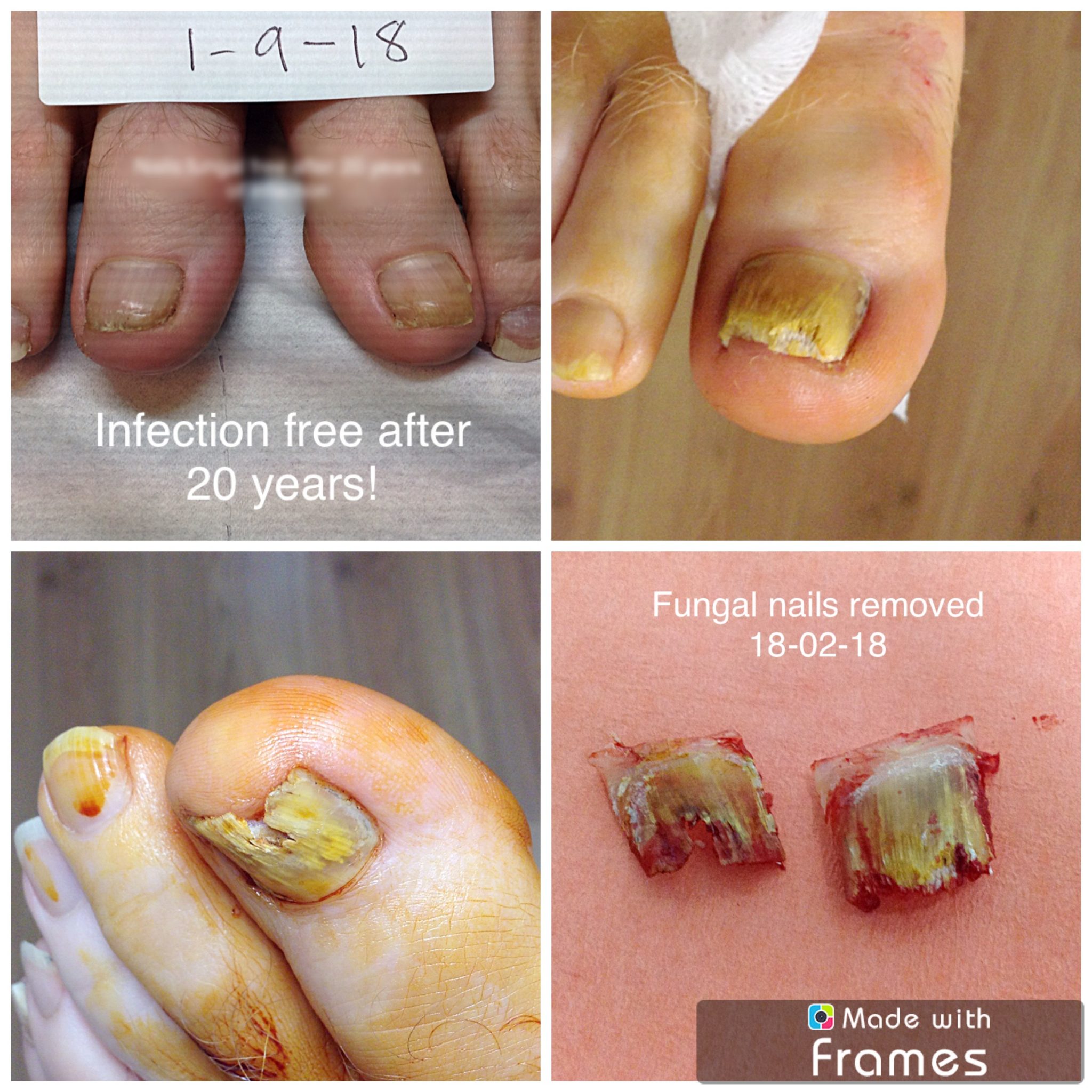 Nail Fungus Treatment, Causes and Prevention