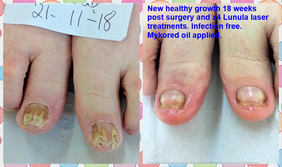 95% Effective Fungal Nail Treatment Cure - Compleet Feet