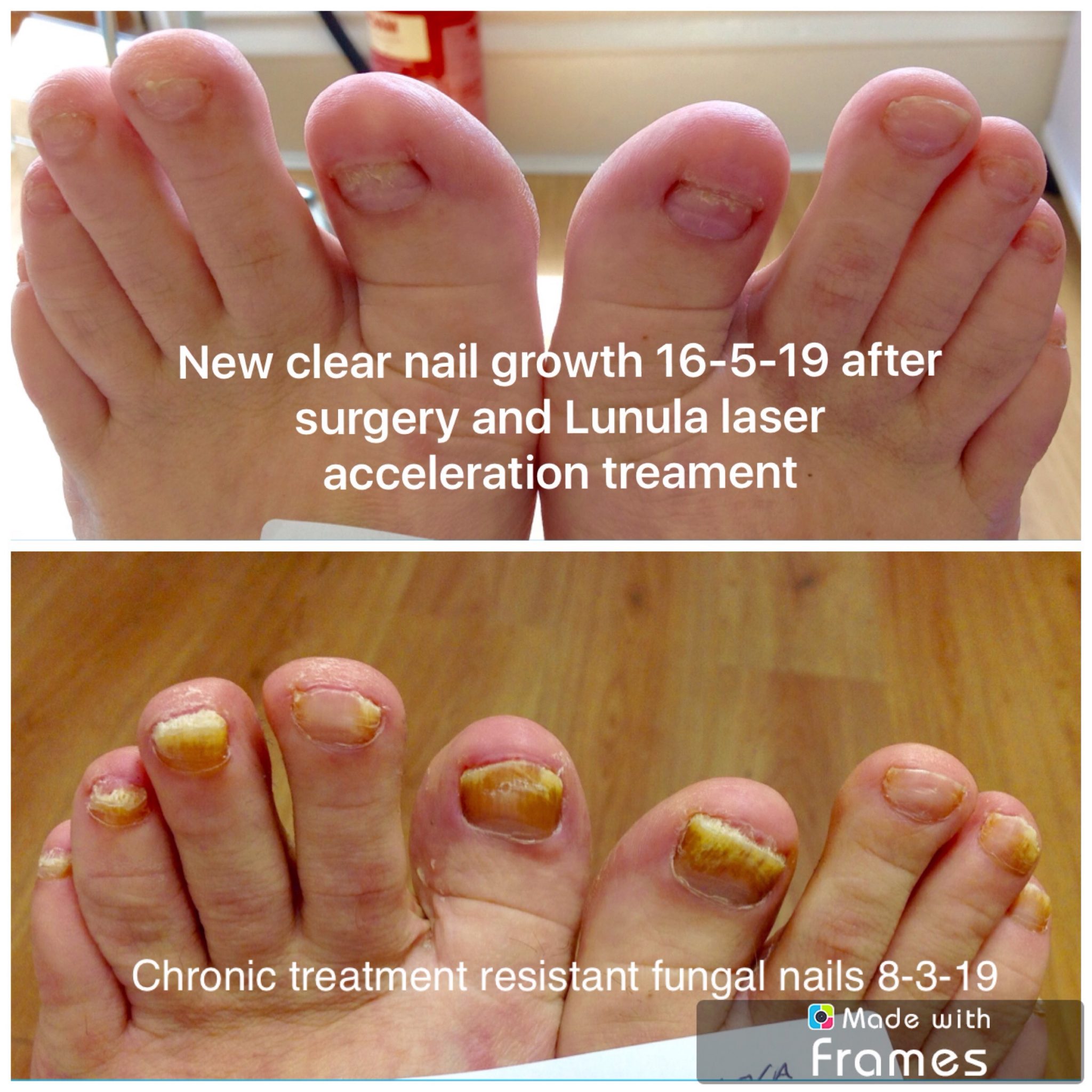 Fungal Nail Treatment Darlington - Laser Fungal Nail Treatment