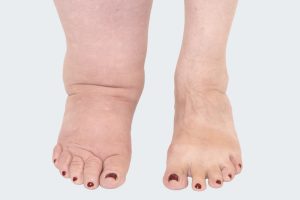 shoes for oedematous feet
