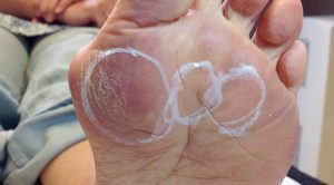 Foot Dermal Filler Injections for Fat Pad Atrophy