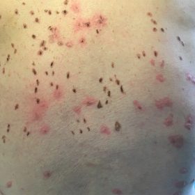 Image shows scabbing from previous cryotherapy treatment and inflammation post freezing after 2nd treatment. Scabbing is superficial