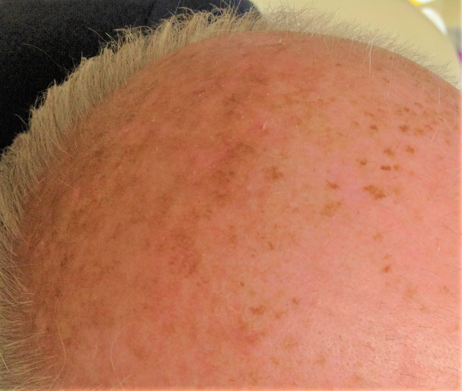 Cyrotherapy For Skin Growths in Alton, Hampshire.