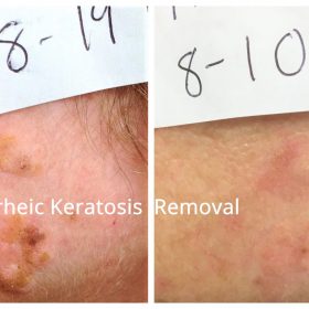 Before and after photographs of seborrheic keratosis removal