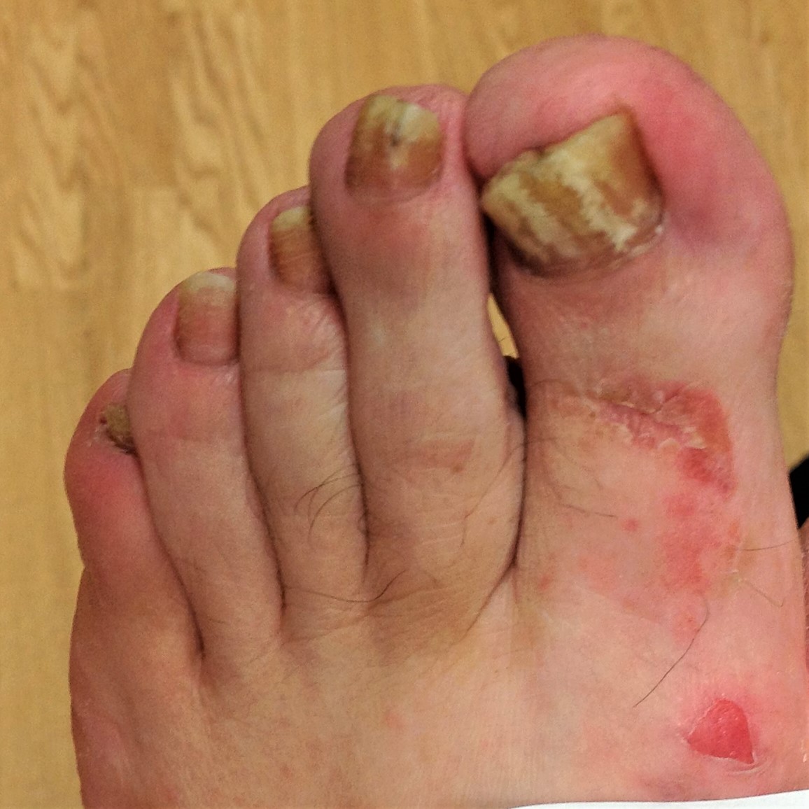 Home  Treat Fungal Nails Now – Katrina’s Tips and Advice on Self-Help