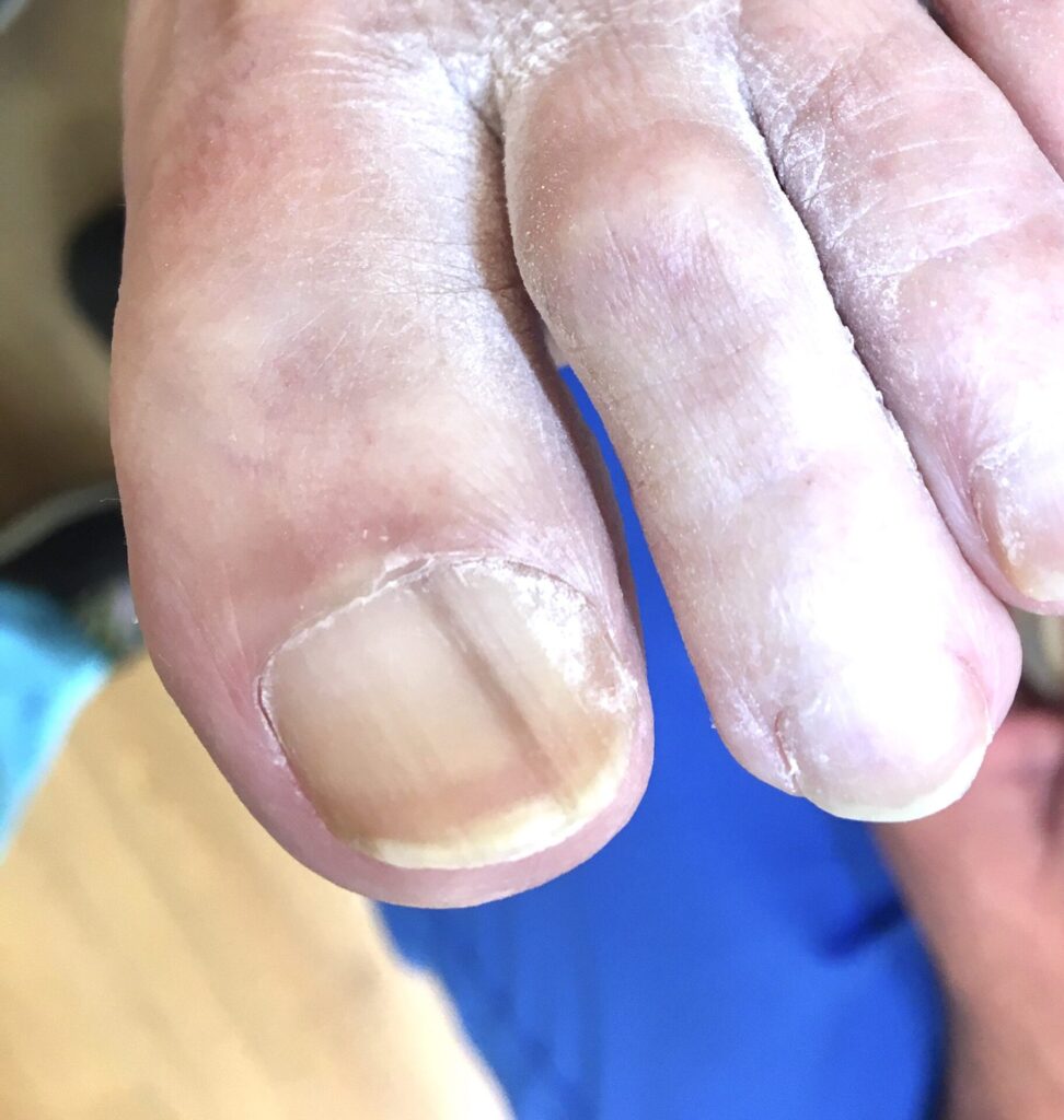 Black Spot In Toenail