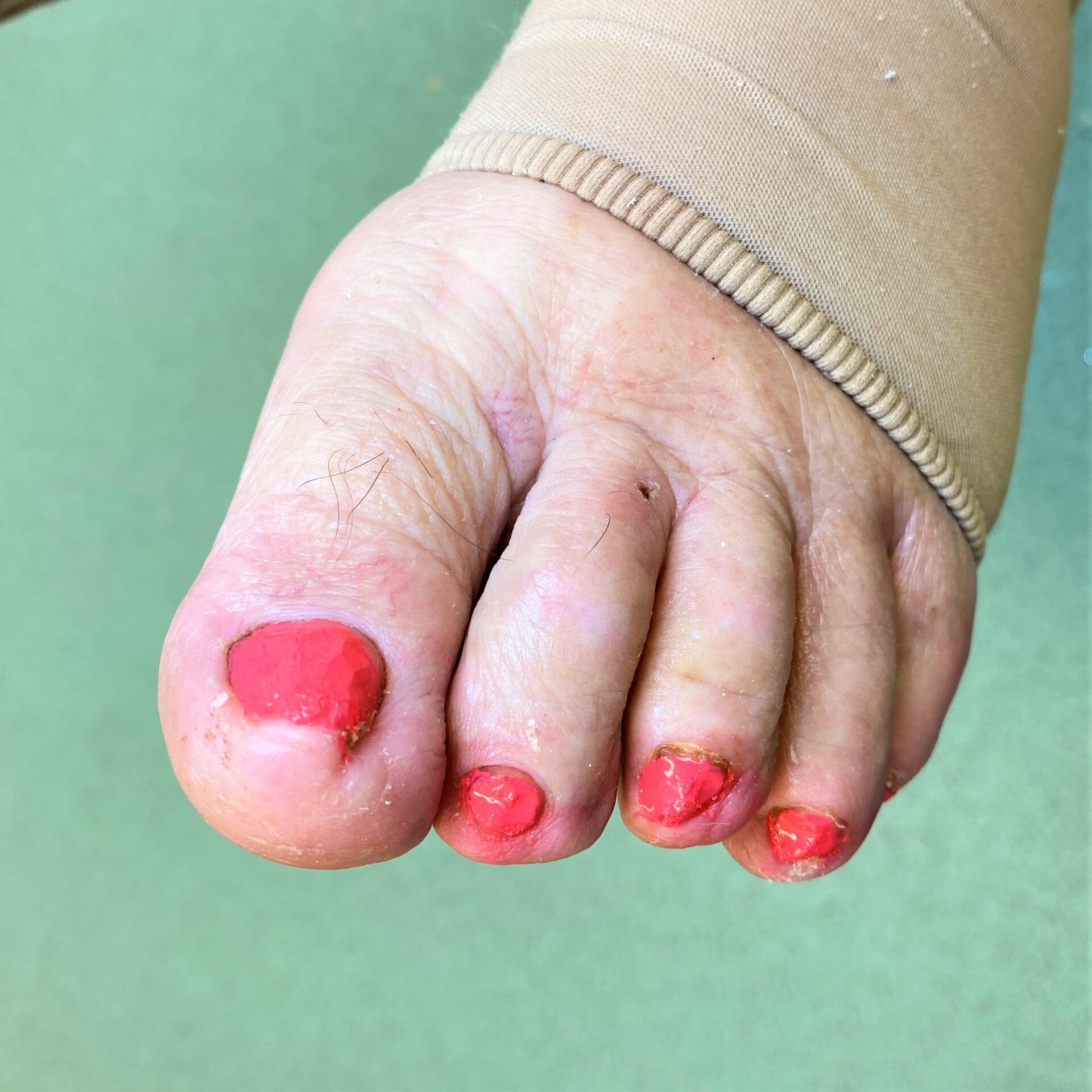Thick nail painted after treatment