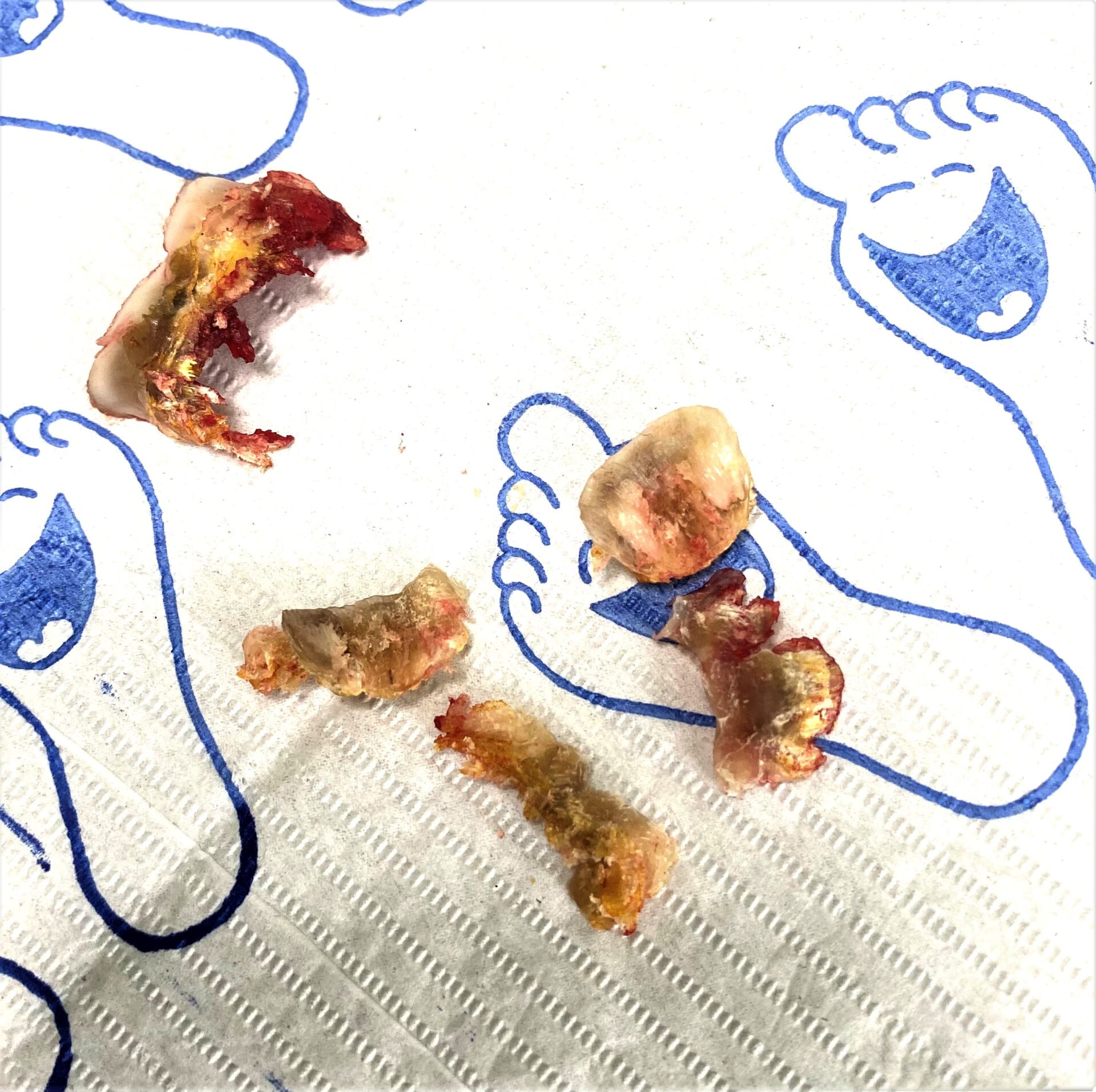 Thick damaged nail plates after surgical removal