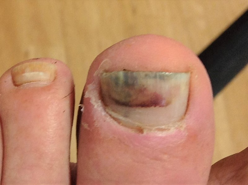 Premium Photo  Big toe nail injury removes dead nail