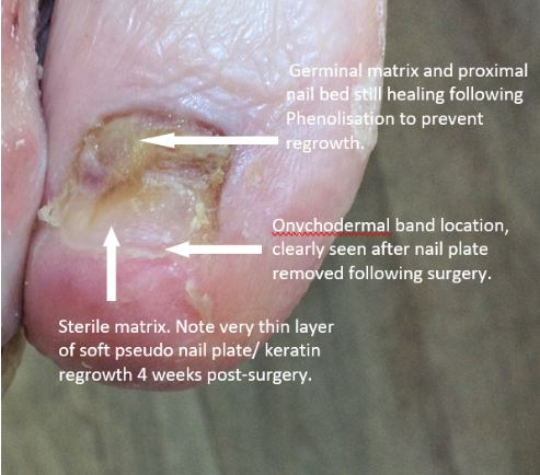 How To Address Nail Bed Injuries
