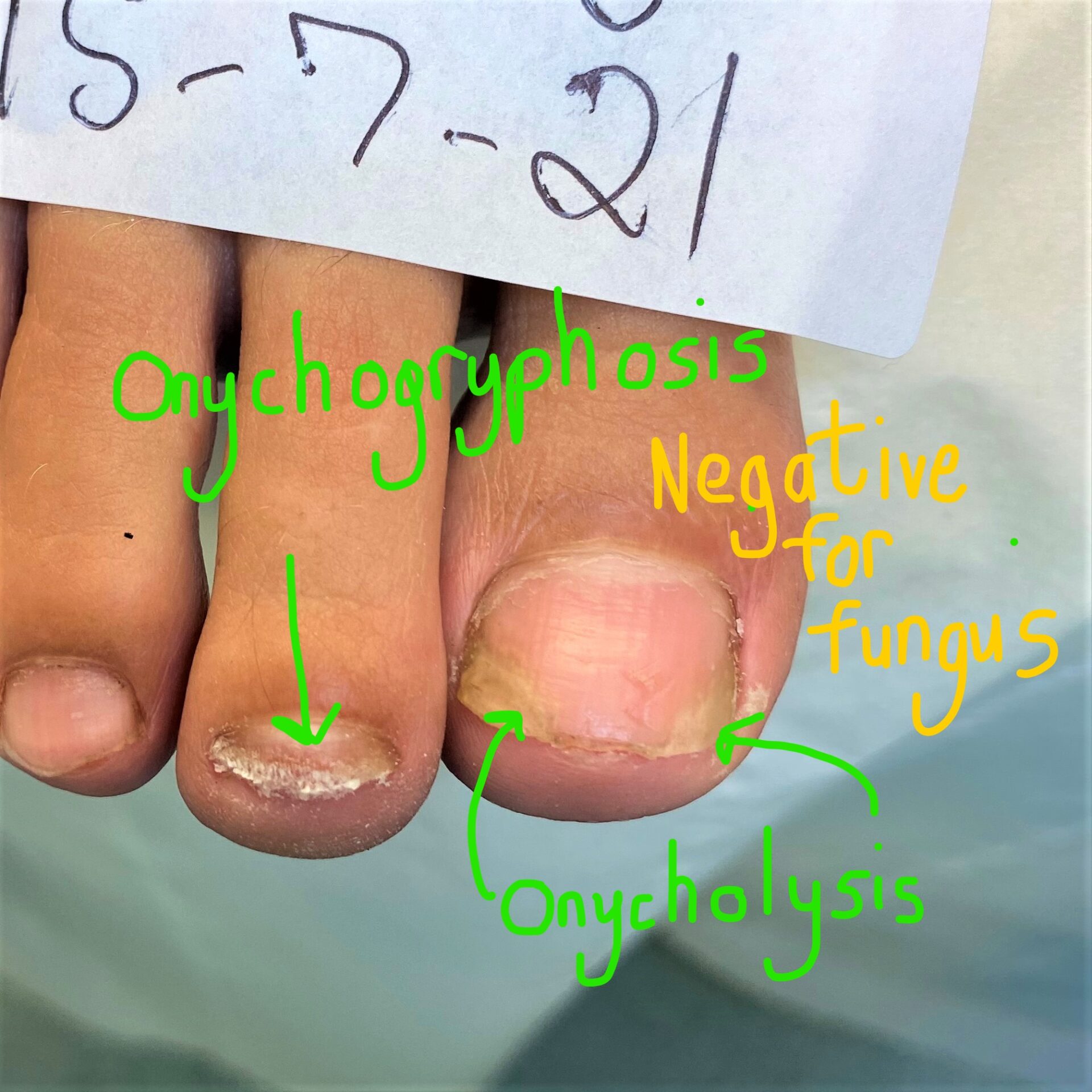 Onychodermal Band Damage and Nail Thickeneing 3