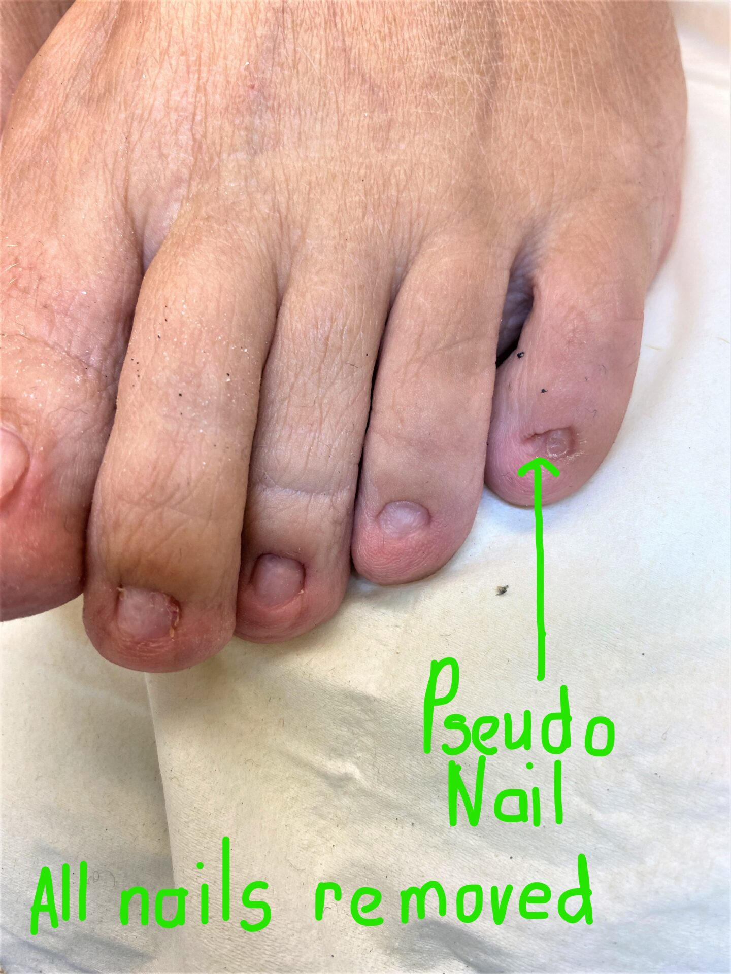 Pseudo nail left after permanent nail surgery