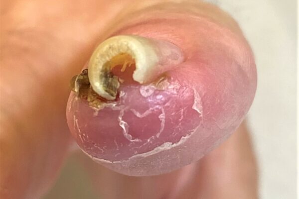 Chronic ingrown fingernail