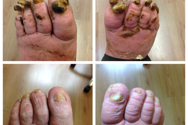 Foot Make-Over at Compleet Feet