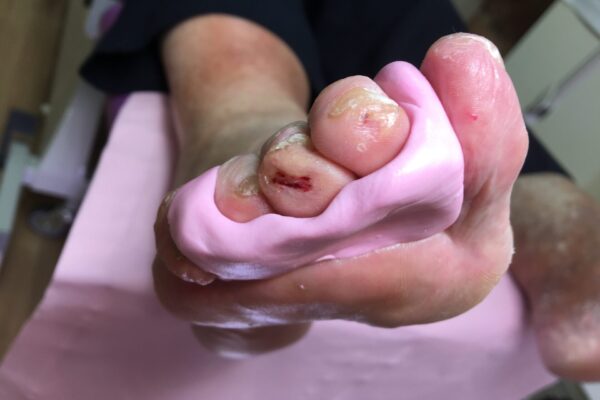 Toe prop for hammer toes