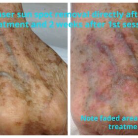 Laser hand sun spot removal
