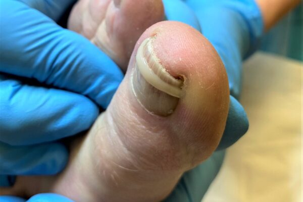 Onyfix Nail Correction Brace at Compleet Feet
