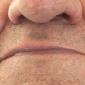 Benign growth removal after