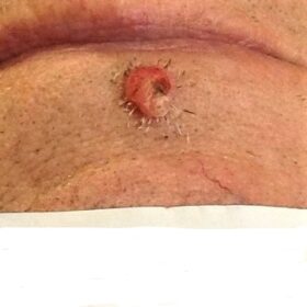 Benign skin growth removal