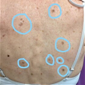 Seborrheic Keratosis Multiple Back