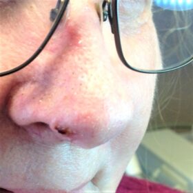Skin Growth Nose After