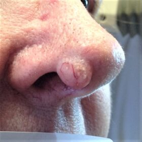 Skin Growth Nose Before