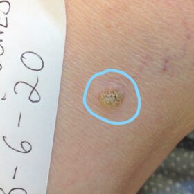 Warty cutaneous growth