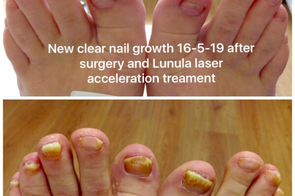 Fungal Nail Treatments