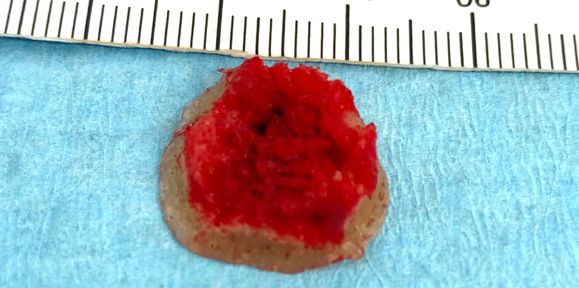 Treatment Resistant HPV Verrucae.  Hypothesis of Verruca ‘Pseudo-Biofilms’. Part 1. 2025
