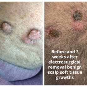 Scalp electrosurgical removal benign soft tissue growths (1)