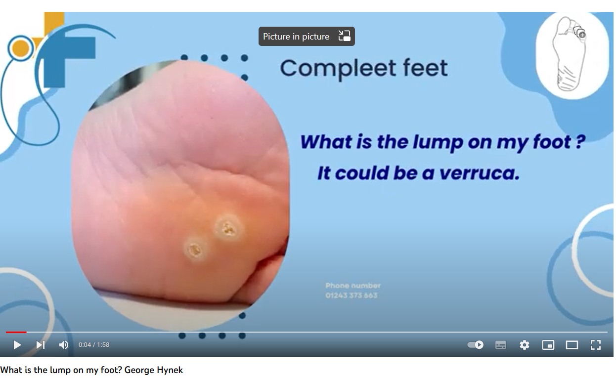 What is that lump on my foot? By George Hynek